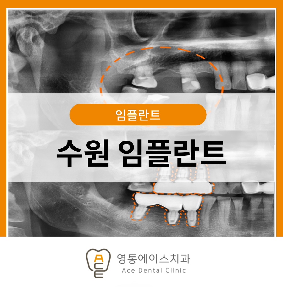 망포동임플란트