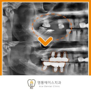 망포동임플란트