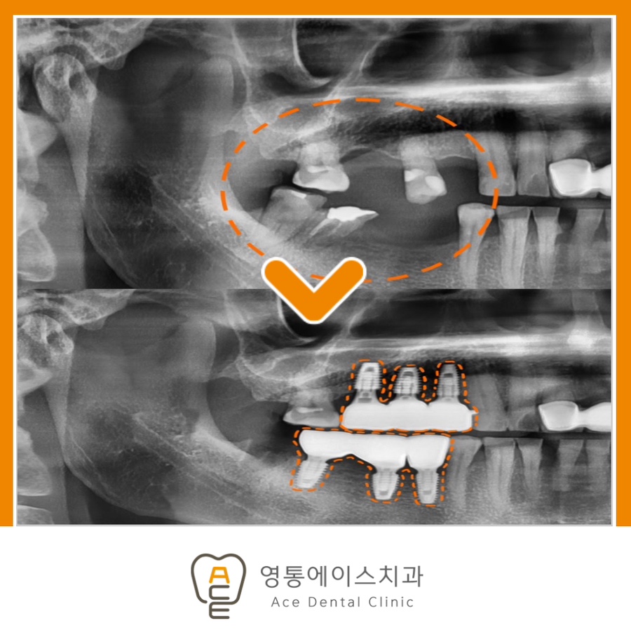 망포동임플란트