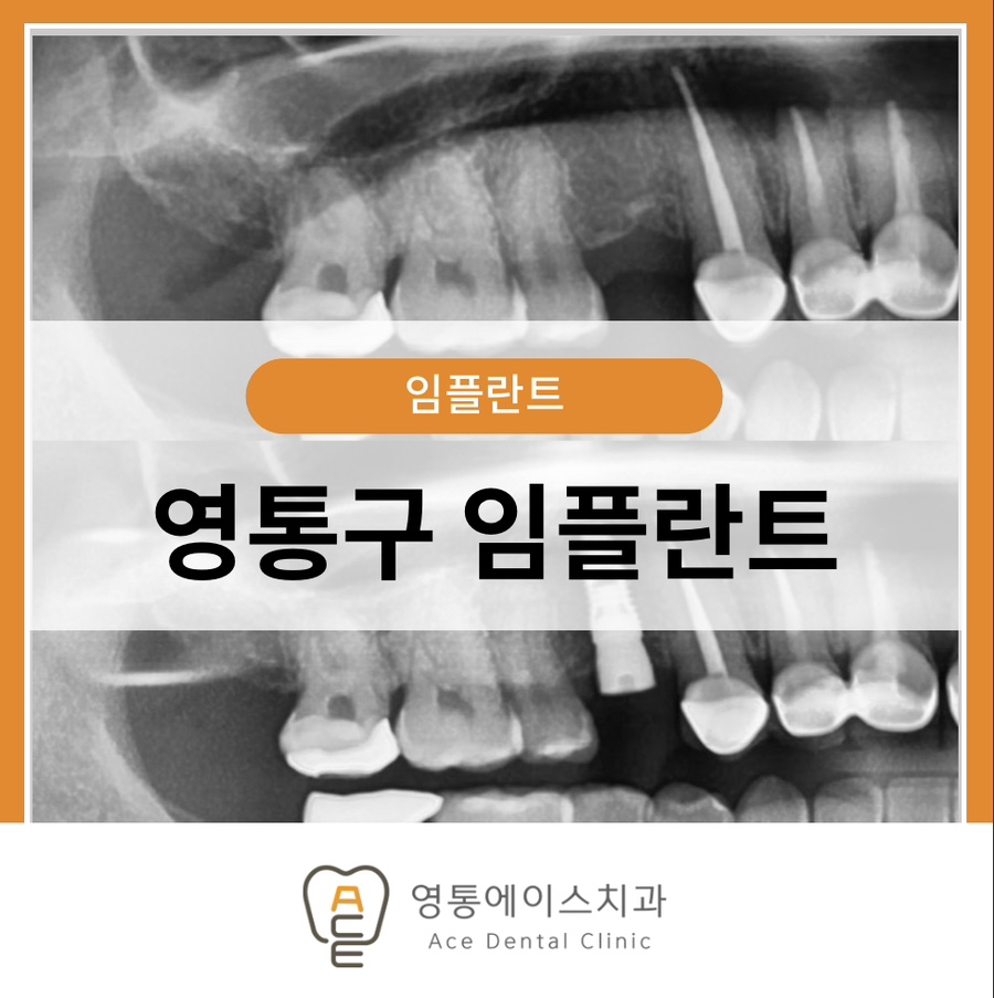 망포역임플란트