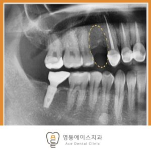 망포역임플란트