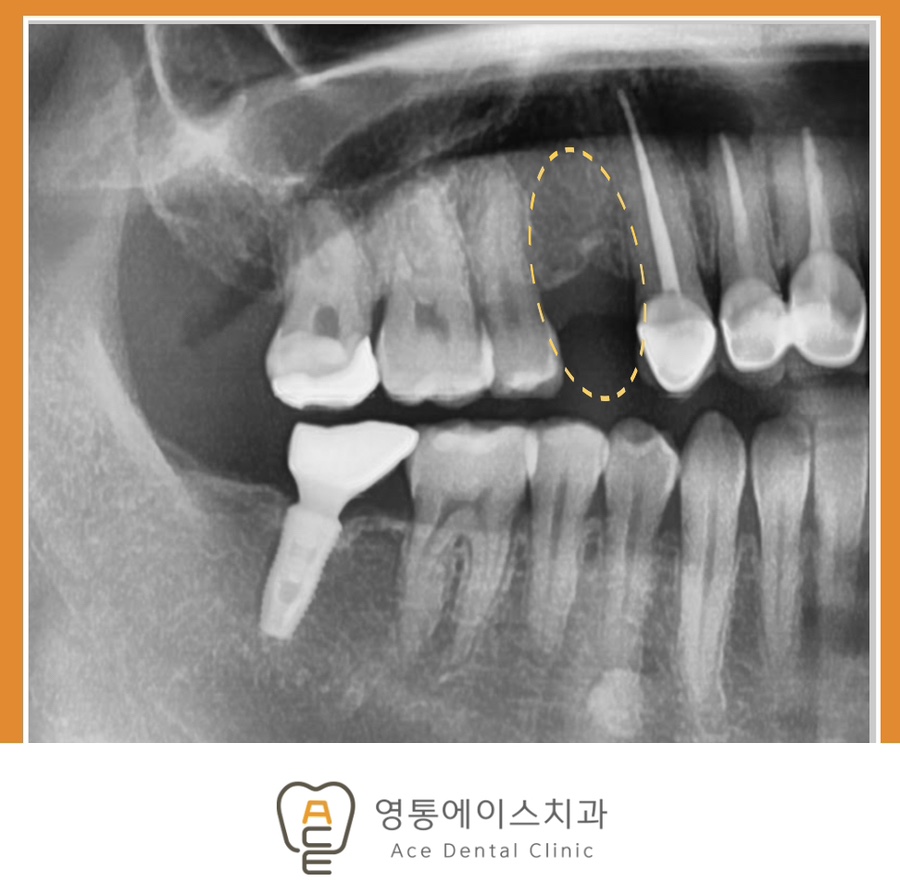 망포역임플란트