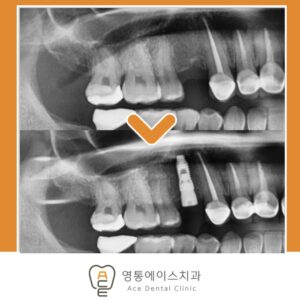 망포역임플란트