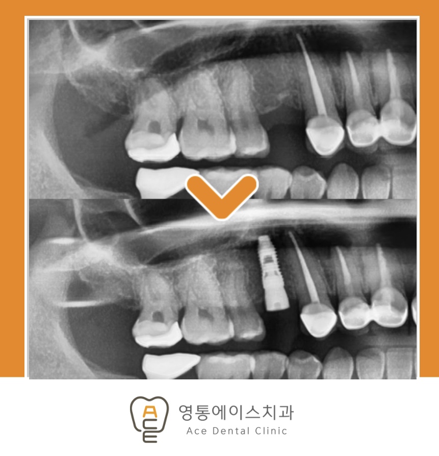 망포역임플란트