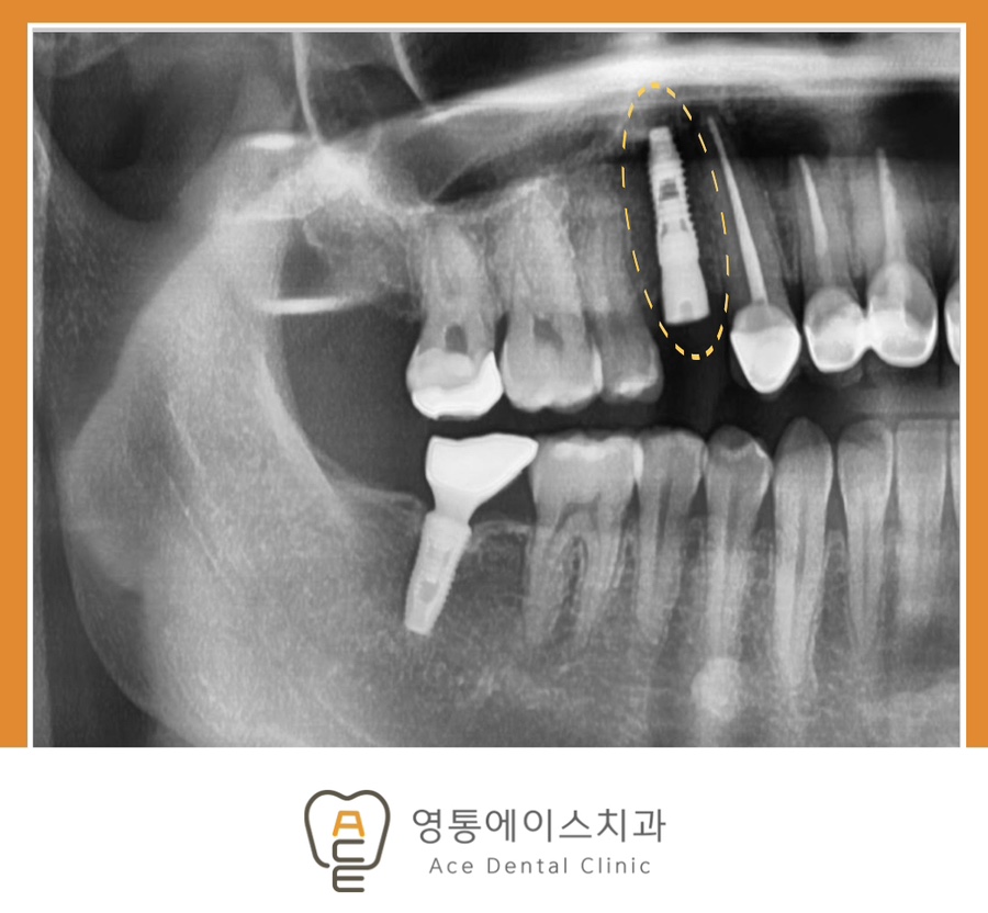 망포역임플란트