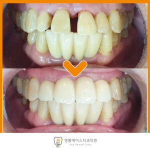 망포역보험임플란트