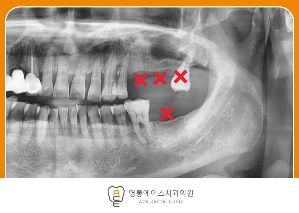 치료 전 사진/2025. 02. 07