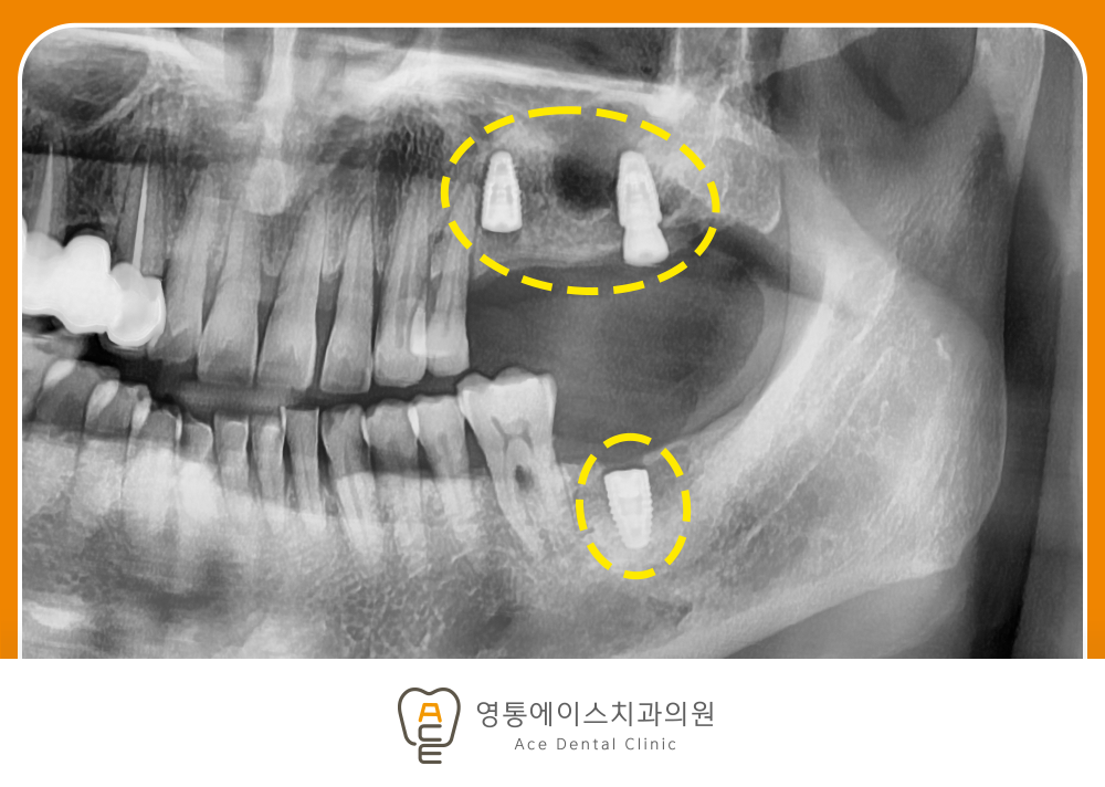망포역보험임플란트