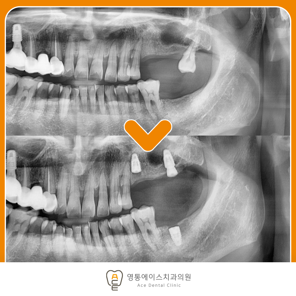망포역보험임플란트