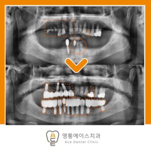 망포역보험임플란트