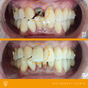 망포역보험임플란트