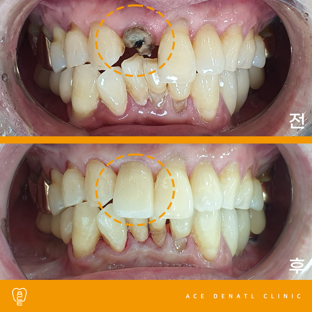 망포역보험임플란트