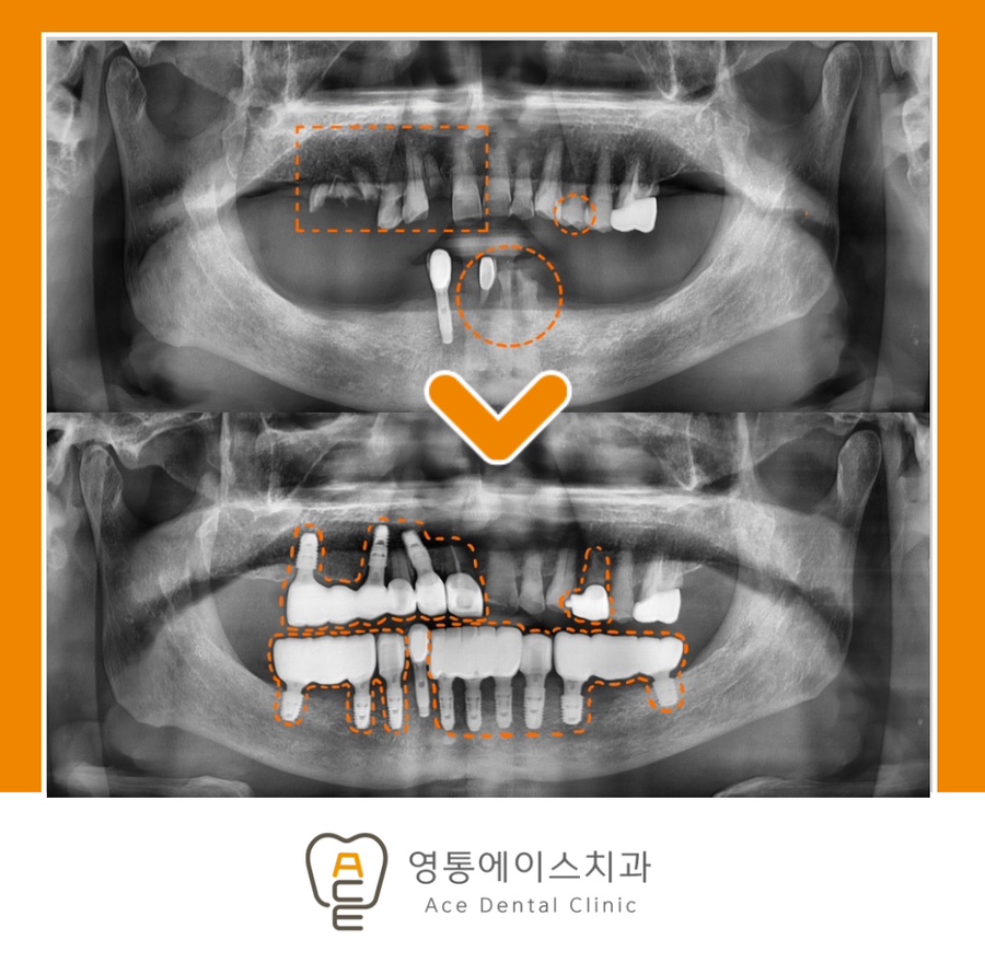 망포역보험임플란트