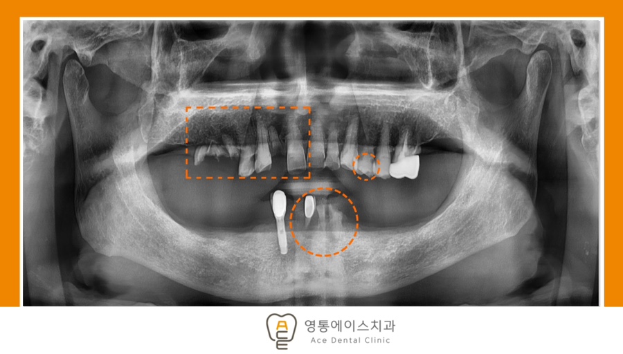 망포역보험임플란트