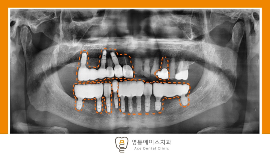 망포역보험임플란트