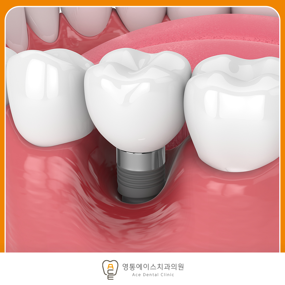 망포역임플란트