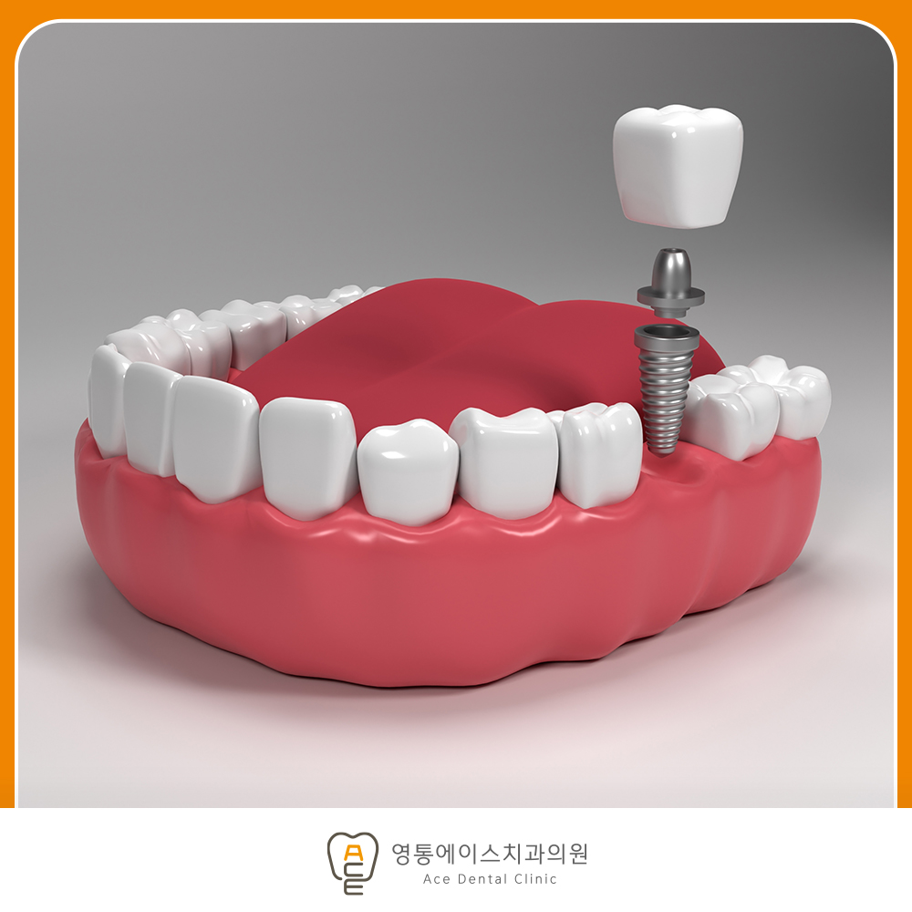 망포역임플란트