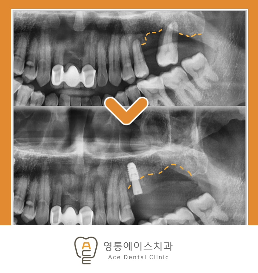 망포역임플란트