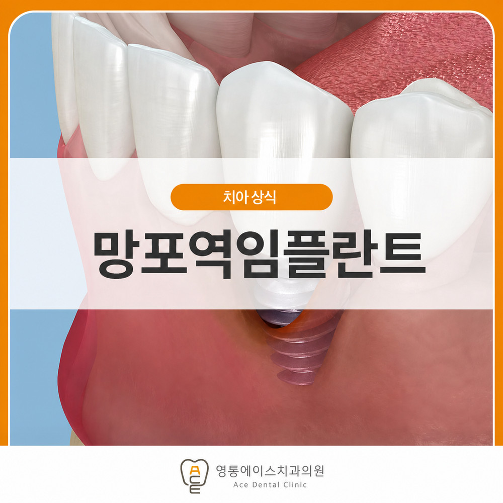 상실 치아를 대체한 망포역임플란트의 사후 관리