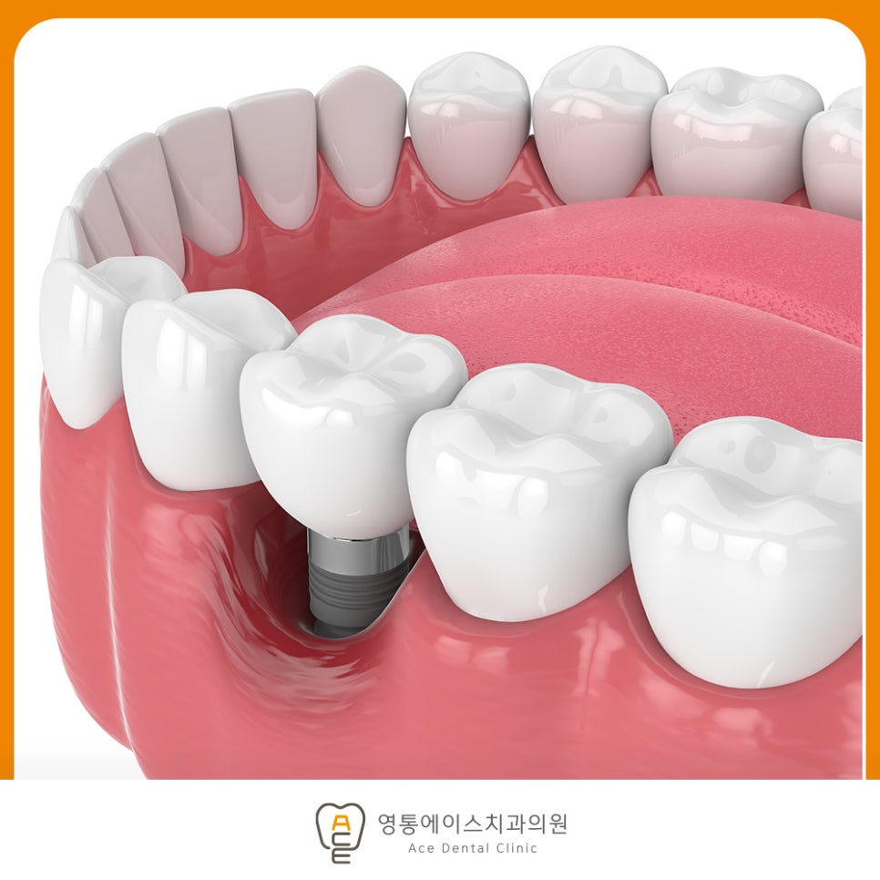임플란트 주변 잇몸이 붓고 피나는 초기 증상