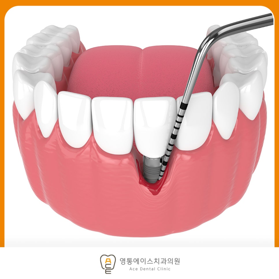 염증으로 지지 뼈가 흡수된 임플란트 상태