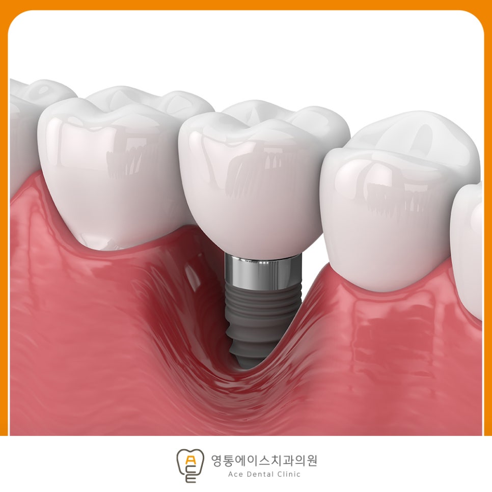정기 검진과 스케일링을 받는 임플란트 관리