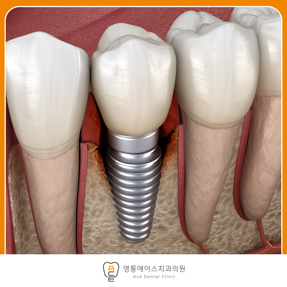 망포역임플란트