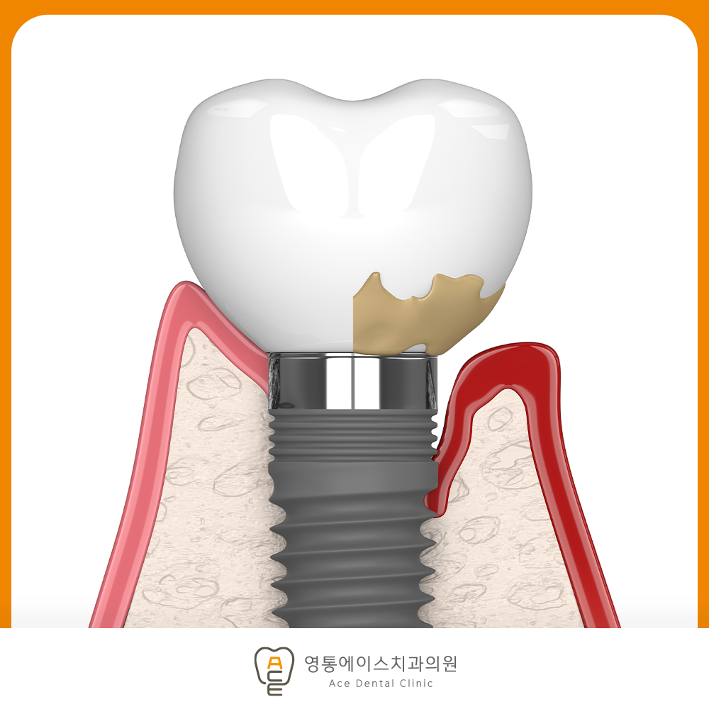 망포역임플란트