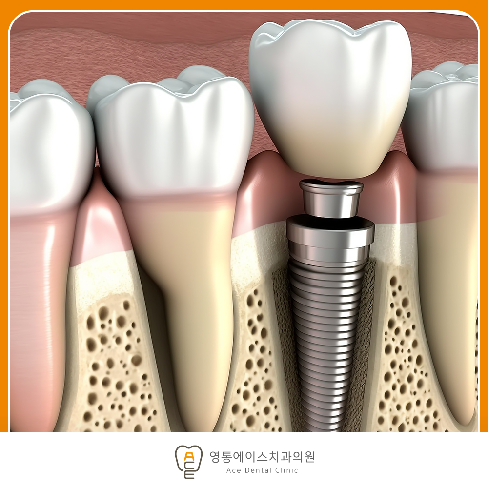 망포역임플란트