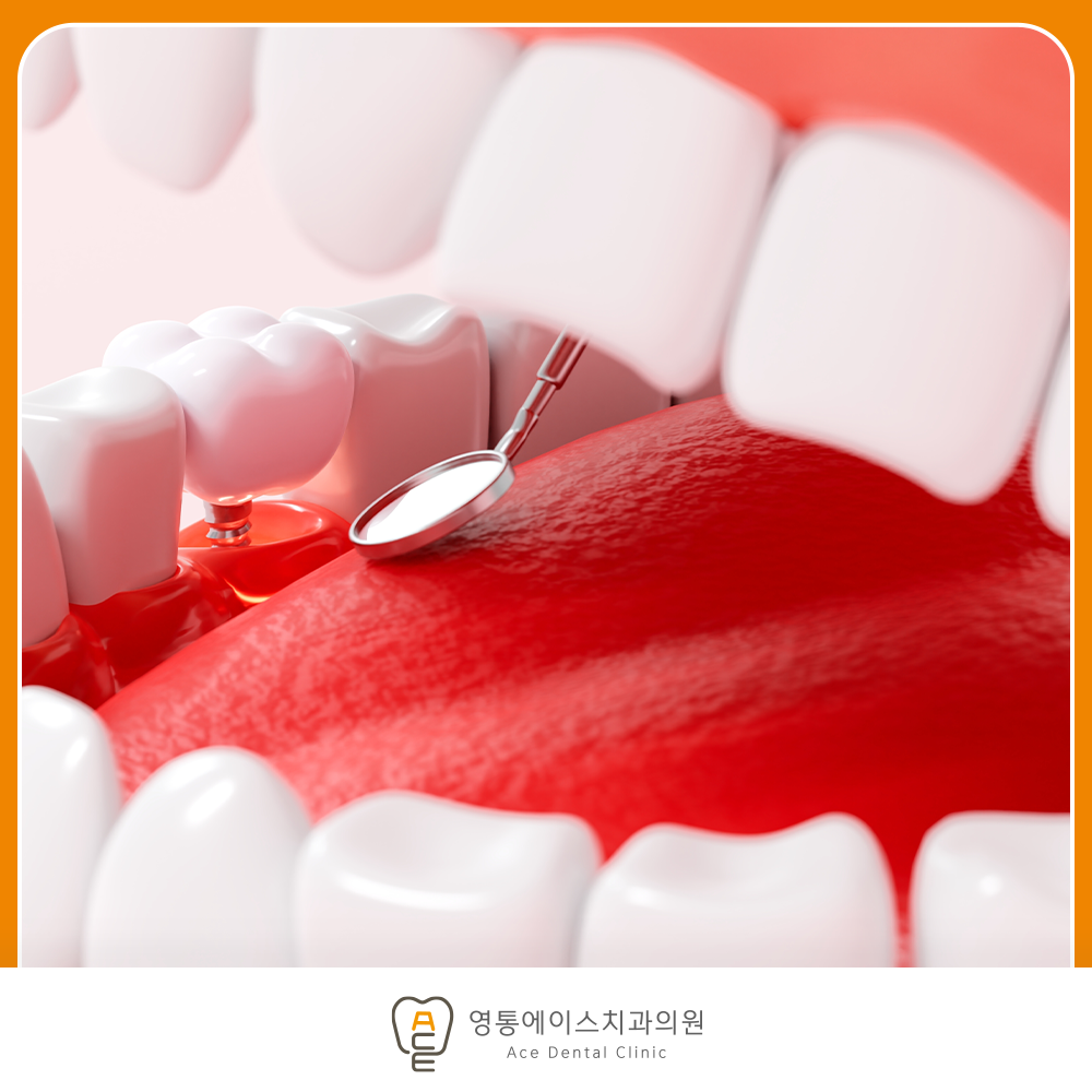 망포역임플란트
